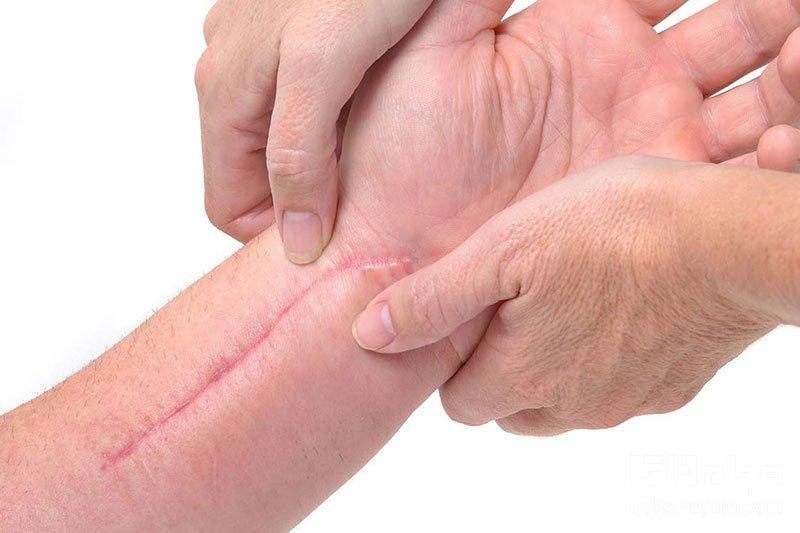 روش های از بین بردن جای زخم و بخیه روش های از بین بردن جای زخم و بخیه