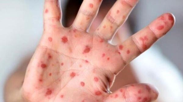 آماده باش در ژاپن در پی شیوع مجدد یک بیماری قدیمی آماده باش در ژاپن در پی شیوع مجدد یک بیماری قدیمی