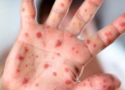 آماده باش در ژاپن در پی شیوع مجدد یک بیماری قدیمی